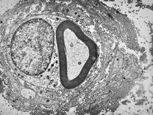 F,23y. | - n.suralis- hypertrophic demyelinizing neuropathy (onion bulbs)